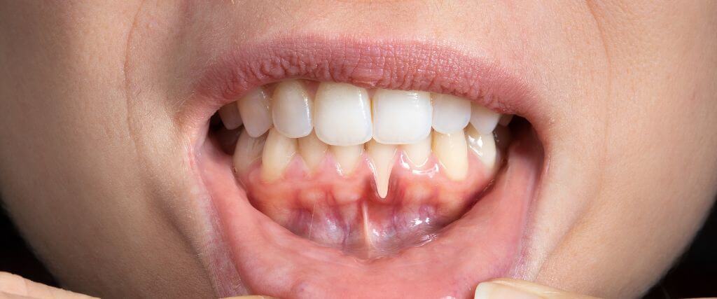 Gum Recession: Causes, Treatment, and Prevention