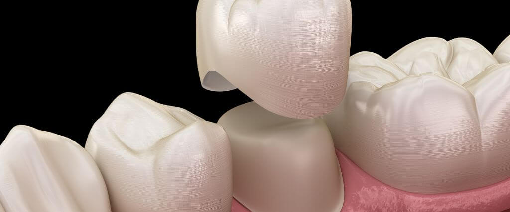 Types of Dental Crowns: Choosing the Right Material for Your Smile